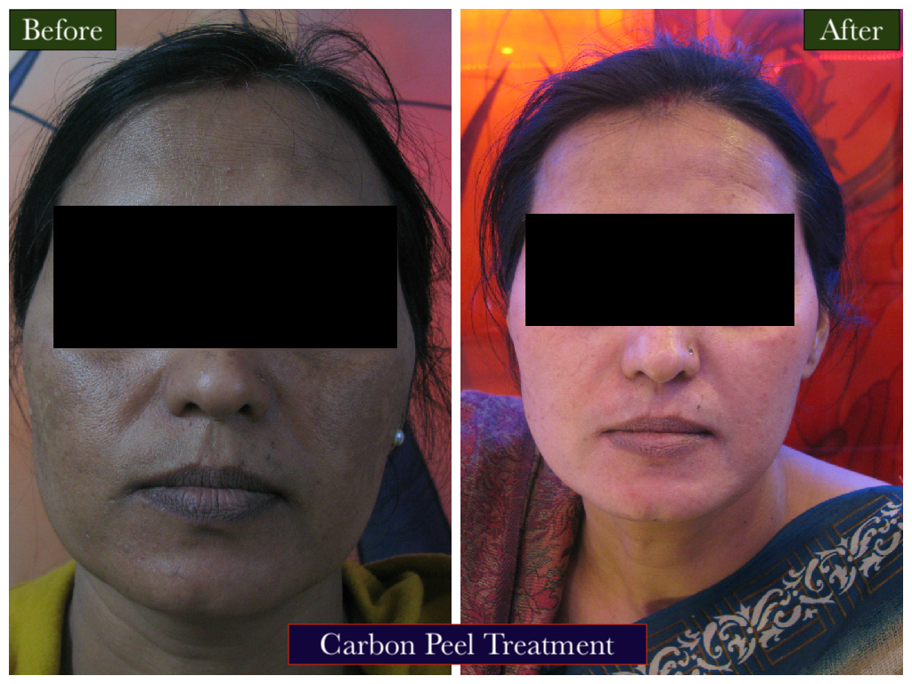 Carbon Peel Treatment